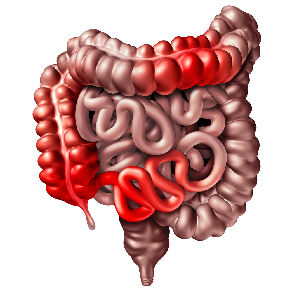 Crohn Disease, human intestines with inflammation 