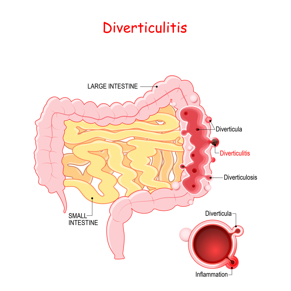 Diverticulosis and Diverticulitis