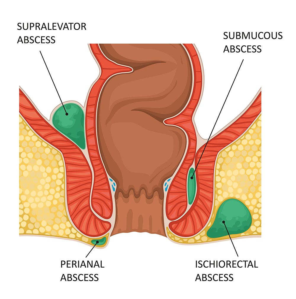 Anal abscess. Vector illustration