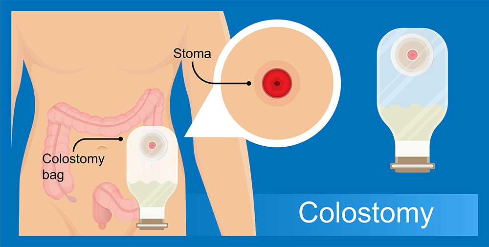Colostomy bag stoma ostomy patient screening