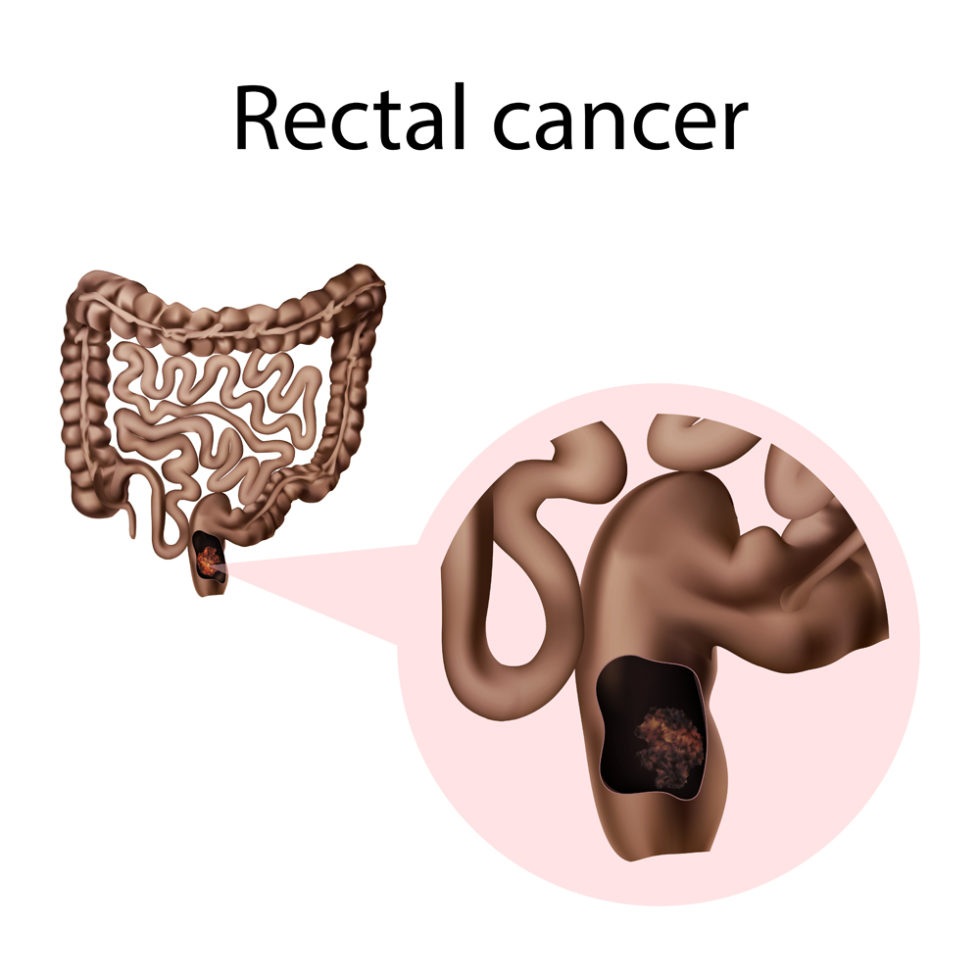 Rectal Cancer Raleigh, NC UNC REX Colorectal Surgery