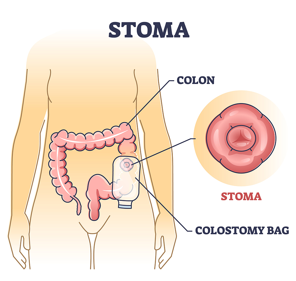 Stoma bag after colon surgery as medical patient drainage outlin